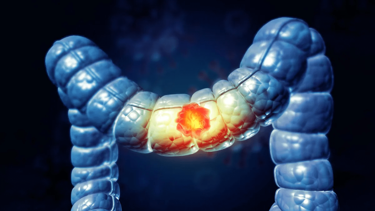 Immunoterapia tumore colon: 9 settimane prima della chirurgia tengono i pazienti senza recidiva