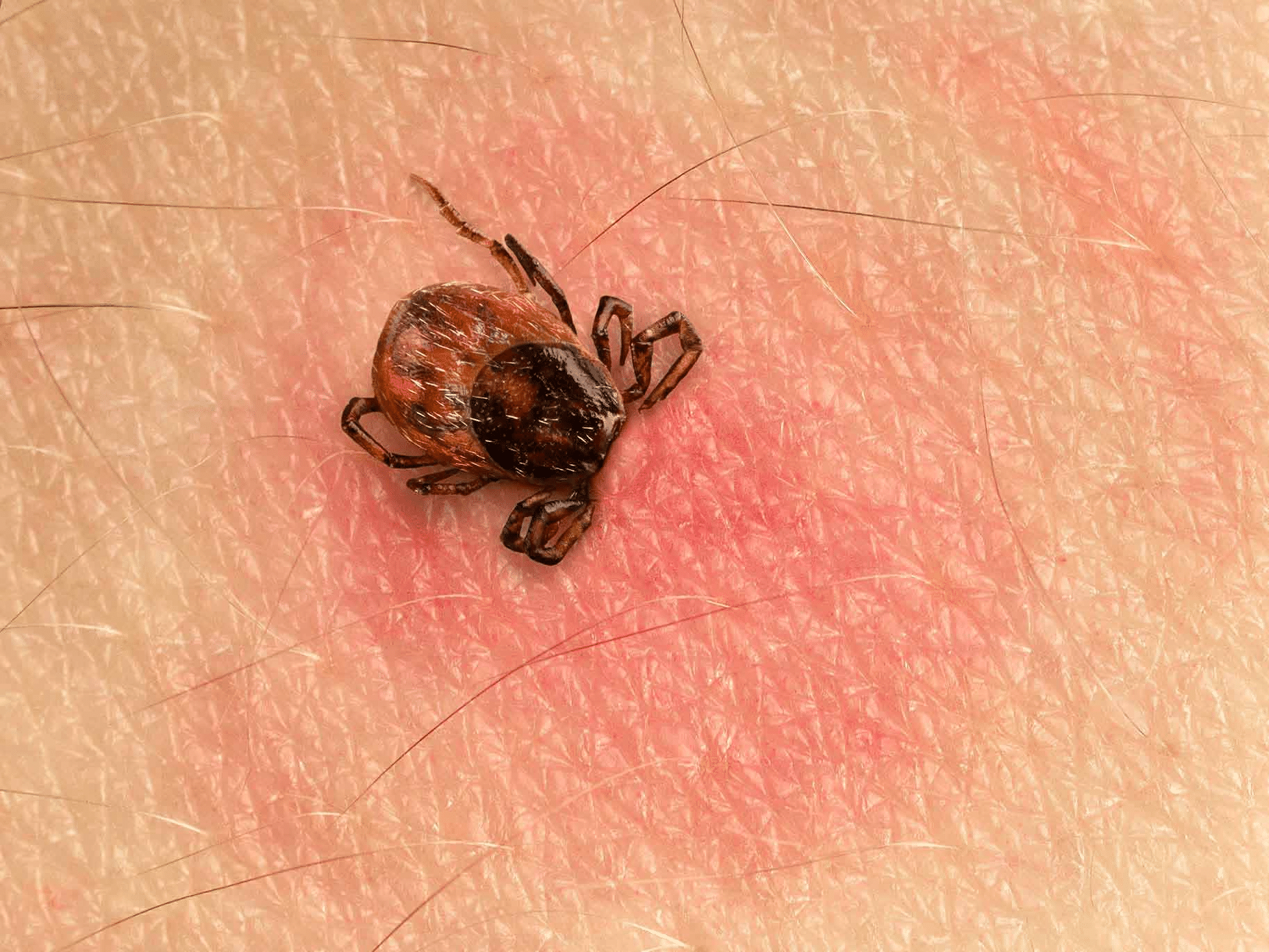 Sintomi di una puntura di zecca: non ignorare questa macchia, anche se non hai visto il parassita %sintomi di una puntura di zecca: non ignorare questa macchia, anche se non hai visto il parassitacount(title)% Sintomi di una puntura di zecca: non ignorare questa macchia, anche se non hai visto il parassita