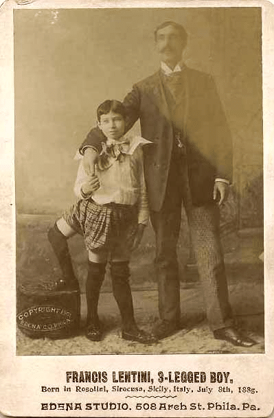 Frank lentini da giovane, il siciliano nato nel 1889 con tre gambe