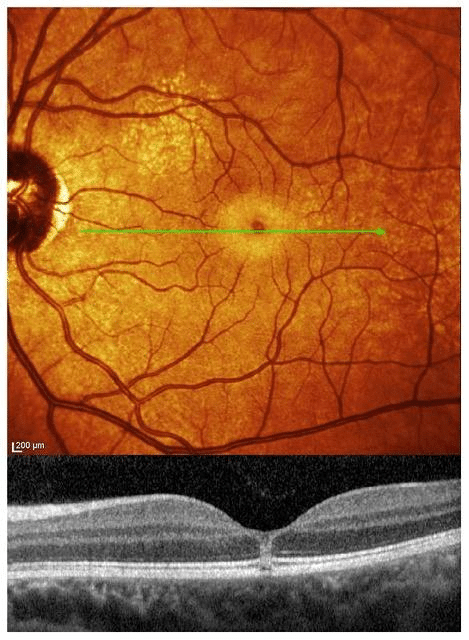 Hai guardato l’eclissi e ti fanno male gli occhi? Come capire se hai danneggiato la retina %hai guardato l’eclissi e ti fanno male gli occhi? Come capire se hai danneggiato la retinacount(title)% Hai guardato l’eclissi e ti fanno male gli occhi? Come capire se hai danneggiato la retina