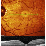 Hai guardato l’eclissi e ti fanno male gli occhi? Come capire se hai danneggiato la retina %hai guardato l’eclissi e ti fanno male gli occhi? Come capire se hai danneggiato la retinacount(title)% Hai guardato l’eclissi e ti fanno male gli occhi? Come capire se hai danneggiato la retina