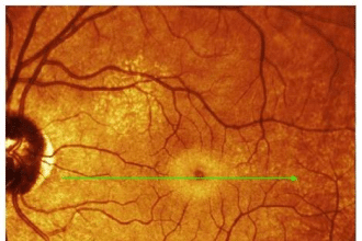 Hai guardato l’eclissi e ti fanno male gli occhi? Come capire se hai danneggiato la retina