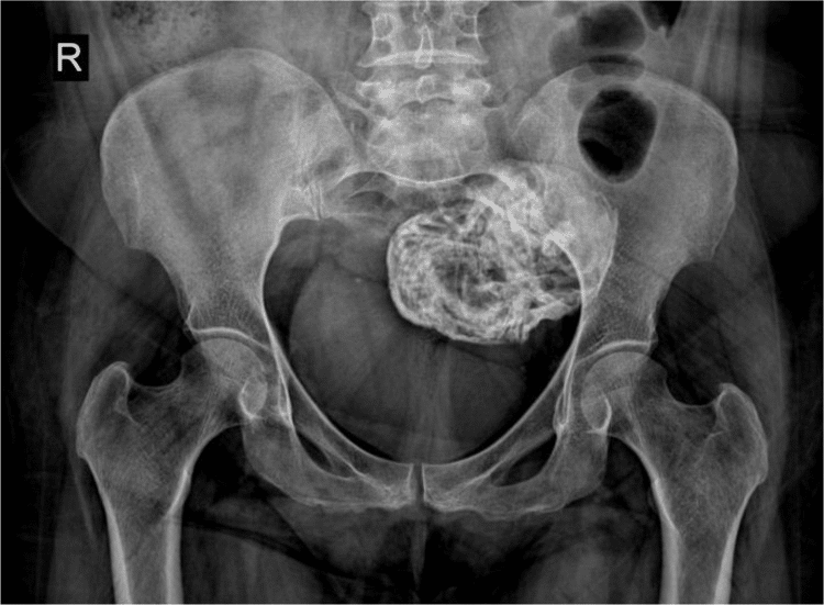 Litopedio: cos’è il “bambino di pietra”, come si forma e quanto può restare nel corpo %litopedio: cos’è il “bambino di pietra”, come si forma e quanto può restare nel corpocount(title)% Litopedio: cos’è il “bambino di pietra”, come si forma e quanto può restare nel corpo