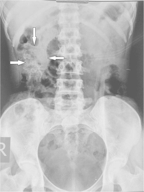 Litopedio: cos’è il “bambino di pietra”, come si forma e quanto può restare nel corpo %litopedio: cos’è il “bambino di pietra”, come si forma e quanto può restare nel corpocount(title)% Litopedio: cos’è il “bambino di pietra”, come si forma e quanto può restare nel corpo